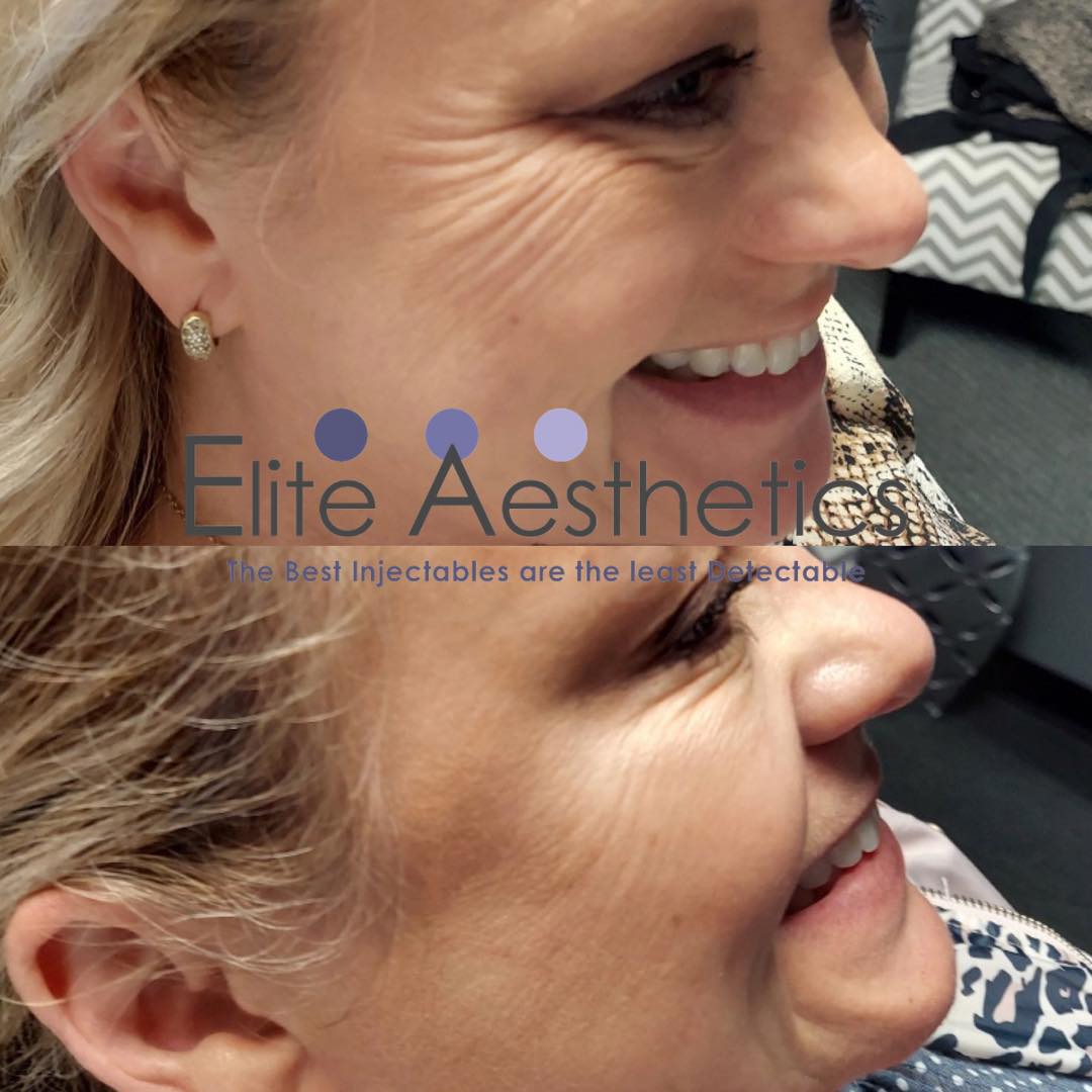 Skin tightening Overland Park Kansas